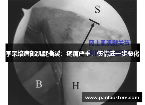 李荣培肩部肌腱撕裂：疼痛严重，伤情进一步恶化